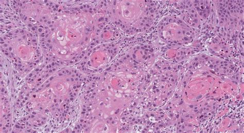 Sinonasal Keratinizing Squamous Cell Carcinoma Atlas Of Pathology