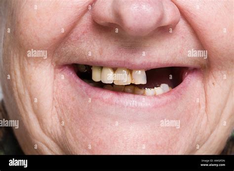 Missing Teeth Woman Hi Res Stock Photography And Images Alamy