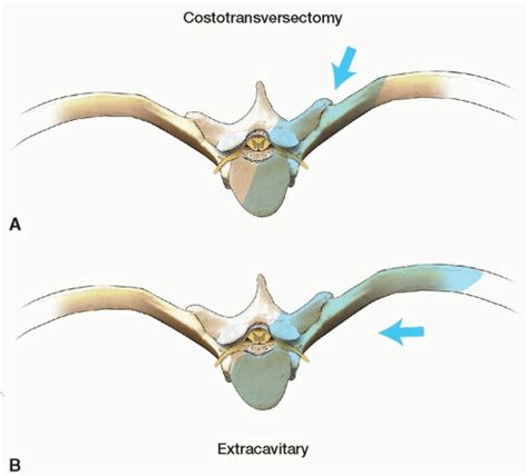 Costotransversectomy And Lateral Extracavitary Approach