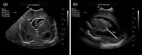 Preterm Neonatal Lateral Ventricle Volume From Three Dimensional