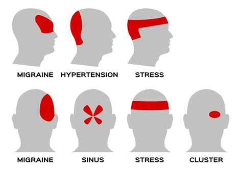 Headache Chart Types By Symptoms Location And Causes Vrogue Co