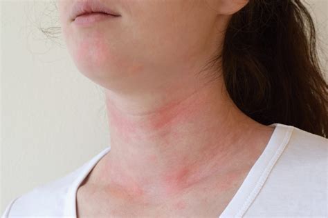 What Are Hives Skin Rash South Tampa Immediate Care