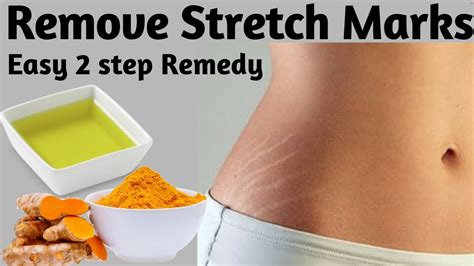 How To Get Rid Of Stretch Marks 2 Steps To Remove Stretch Marks