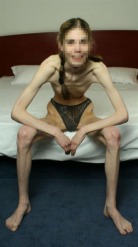 Lauren Mccrostie Anorexia Hot Sex Picture