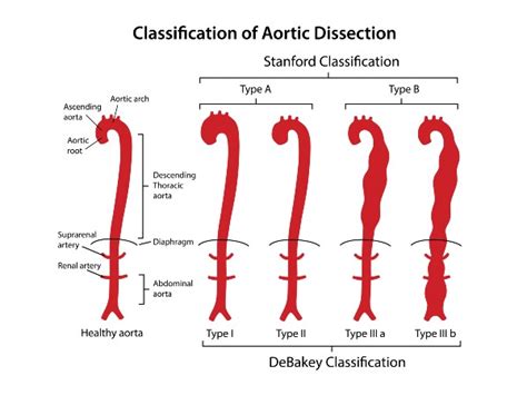 Dilated Aortic Root Associated With Higher Rates Of Aortic Dissection