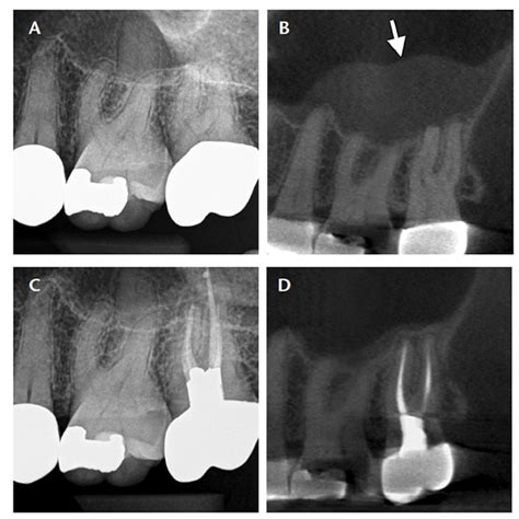 Maxillary Sinusitis Of Endodontic Origin Decisions In Dentistry
