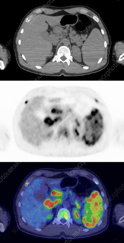 Hodgkin Lymphoma Ct And Pet Scans Stock Image C0584834 Science