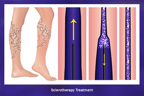 Varicose Veins Or Venous Insufficiency Treatment Vein Clinic Of