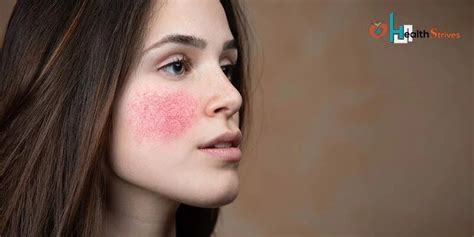 Redness On Face What Are The Causes And How To Treat It