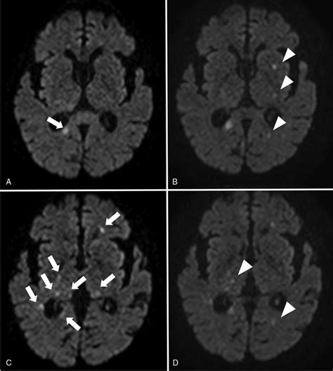 Brain Magnetic Resonance Imaging With Diffusion Weighted Imaging