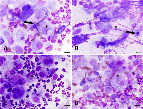 Cytological Features Of Mycoleptodiscus Indicus Subcutaneous Infection