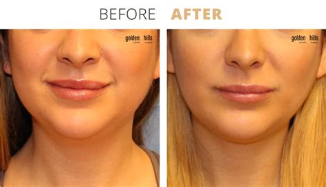 Buccal Fat Pad Removal — Golden Hills Plastic Surgery