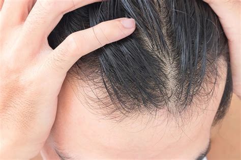Are You Worried About Thinning Hair Trenchpress