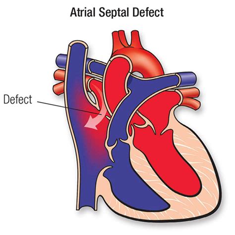 Atrial Septal Defect - Unitamed
