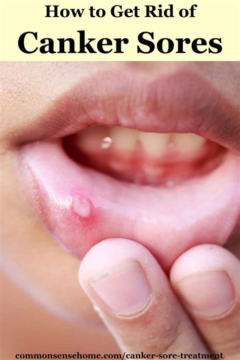 Canker Sore Treatment How To Get Rid Of Canker Sores