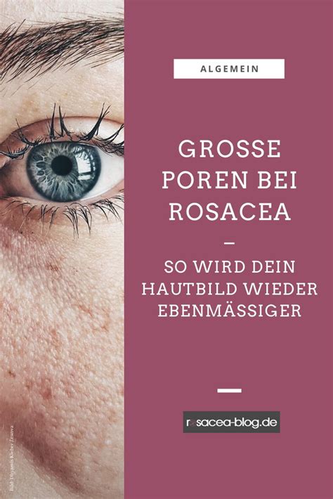 Große Poren Bei Rosacea So Wird Dein Hautbild Wieder Ebenmäßiger