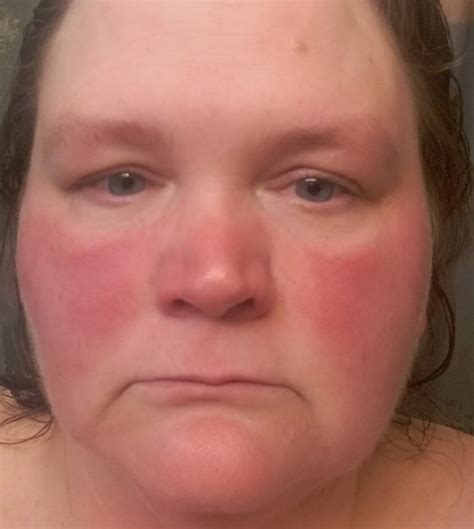 What Do You Think Of This Facial Redness In My Ph Lupus Uk