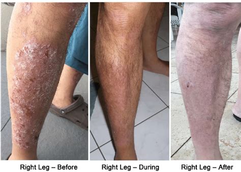 Psoriasis On The Right Leg Before During 2 Weeks And After 4 Weeks