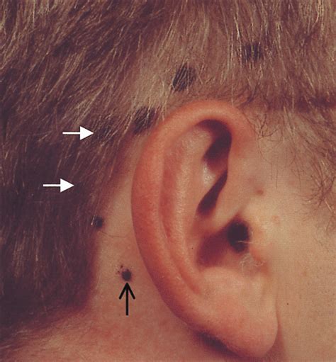 Lymph Nodes Ear Infection My XXX Hot Girl