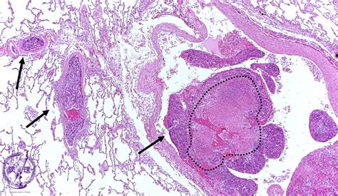 5lung Pleura 20 Metastatic Lung Tumorpathology Core Pictures