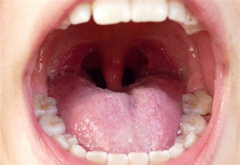 What Are The Potential Effects Of Swallowing Tonsil Stones