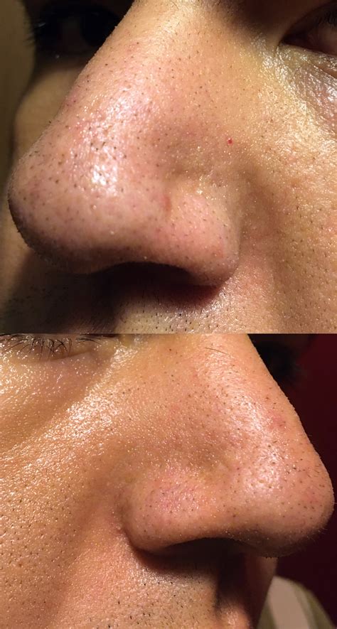 Skin Concerns Any Recommendations With What It Seems Blackheads