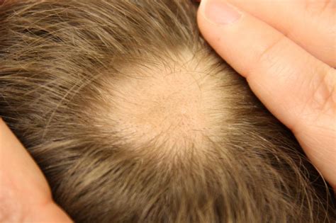 The condition usually is localized when it first appears, as follows Tratamiento láser para la alopecia areata - Clinica San ...