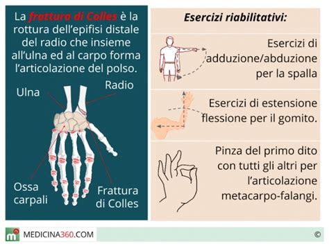 Frattura di Colles: riabilitazione. Esercizi, fisioterapia ...