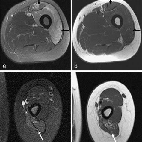 Mr Imaging Of Tibial Nerve Entrapment Near The Popliteal Fossa Axial