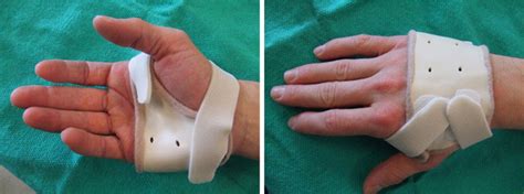 Functional Hand Based Splint In The Treatment Of Metacarpal 42 Off