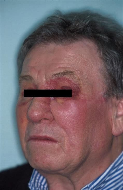 Recurrence 5 Months After First Surgery Periorbital Erythema And