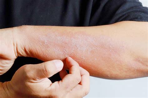 Die neurodermitis wird auch als atopische dermatitis oder atopisches ekzem bezeichnet. Probanden für Studie zur Behandlung von moderater bis ...
