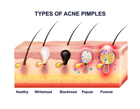 Skin Acne Anatomy Composition Organic Elements Wellness Spa