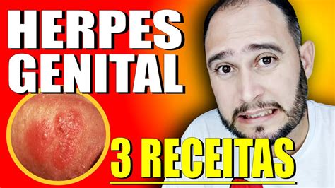 HERPES GENITAL TRATAMENTO Causas Sintomas E 3 Receitas Caseiras Para