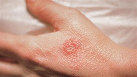 Discover More Than 148 Skin Allergy In Ring Shape Super Hot Netgroup