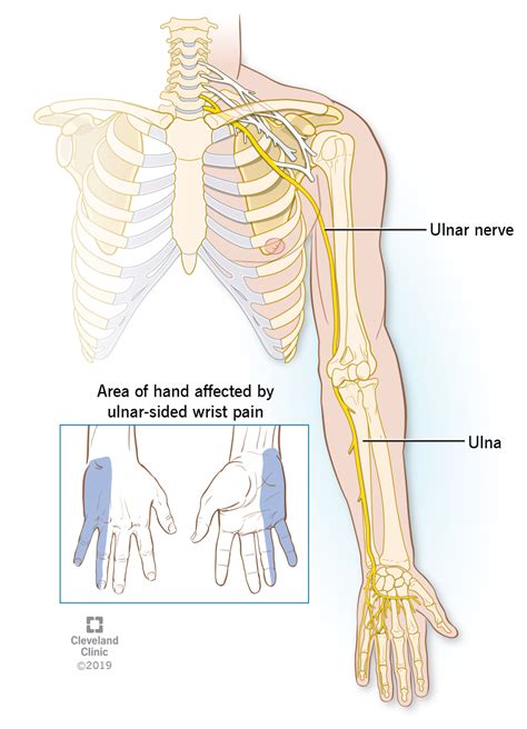 Ulnar Wrist Pain
