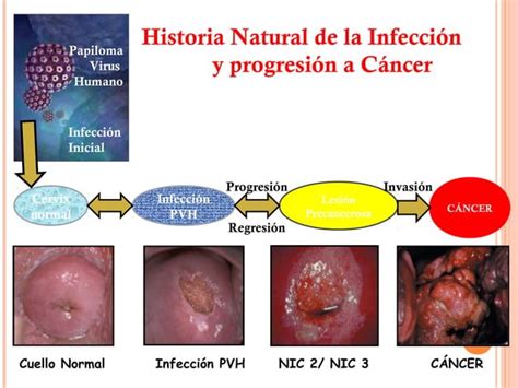 Virus Del Vph Y Cancer De Cuello Uterino