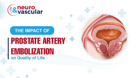 The Impact Of Prostate Artery Embolization On Quality Of Life