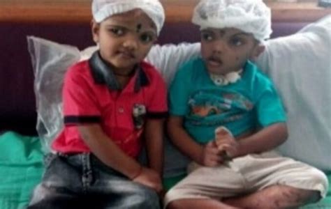 Balia One Of Separated Conjoined Twins From Odisha Dies Sambad English