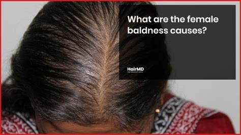 Top Image What Causes Hair Loss In Women Thptnganamst Edu Vn