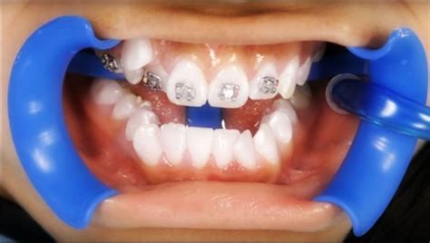 Ortodoncia ¿cómo Es La Colocación De Brackets Directorio Odontológico