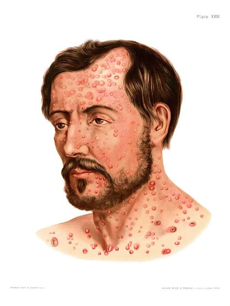 Secondary Syphilis Rash Photograph By Us National Library Of Medicine Science Photo Library Pixels