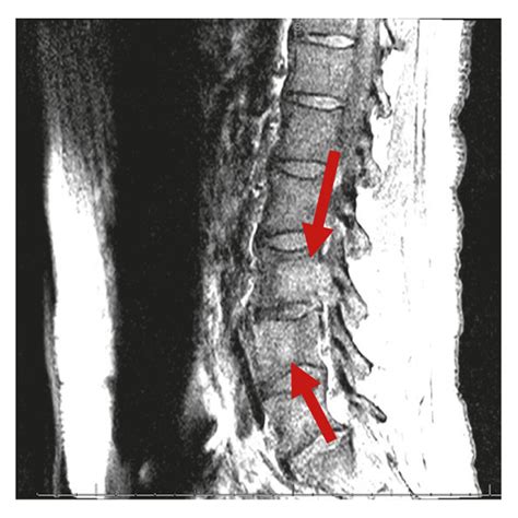 T1 Sagittal Segment Mri Lumbar Spine Download Scientific Diagram