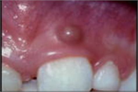 The reddening of the gums and pain are your very first indicators that something is happening. How to Cure a Gum Abscess | Intelligent Dental