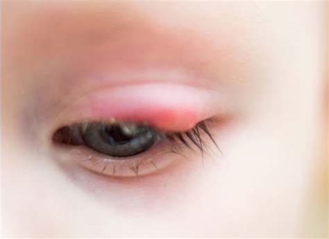 Bisul di kelopak mata, yang biasa disebut bintil, pasti mengganggu kenyamanan. Mengenal Benjolan di Kelopak Mata: Bintitan dan Kalazion