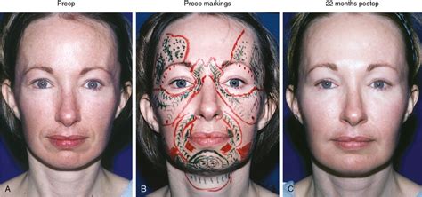 Lipostructure For The Facial Skeleton Plastic Surgery Key