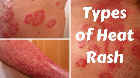 Types Of Heat Rash Heat Rash Types Of Skin Rashes Rashes