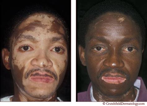Vitiligo Vitiligo Doctor Vitiligo Treament Cure Vitiligo