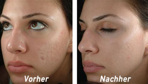 Direkte cremes gegen pickelmale gibt es nicht. Meine Erfahrung mit Mikrodermabrasion - Mikrodermabrasion