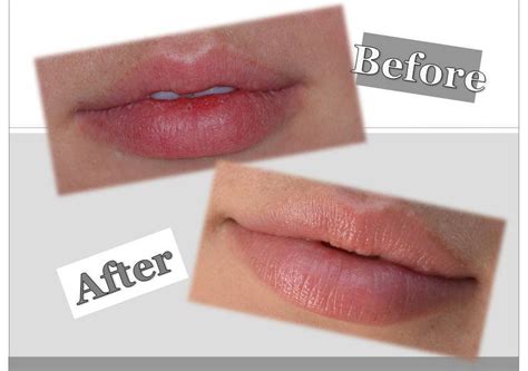 Fuller Lips Dermaworks